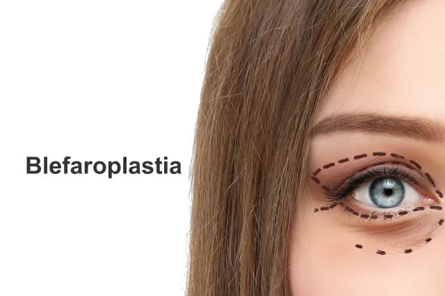 BLEFAROPLASTIA EN QUITO