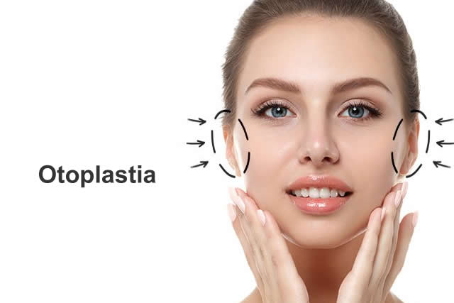 OTOPLASTIA